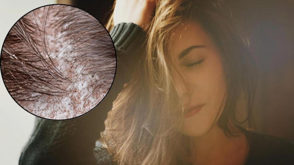 ये पांच गलतियां बढ़ा रही आपके बालों में डैंड्रफ, जान लें कैसे पाएं छुटकारा