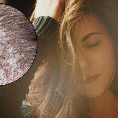 ये पांच गलतियां बढ़ा रही आपके बालों में डैंड्रफ, जान लें कैसे पाएं छुटकारा